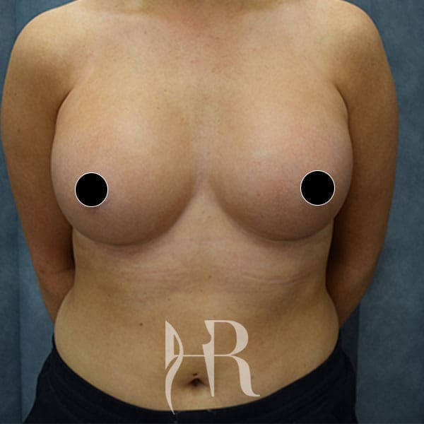 HR Plastic Surgery - Breast Enlargement patient after 13